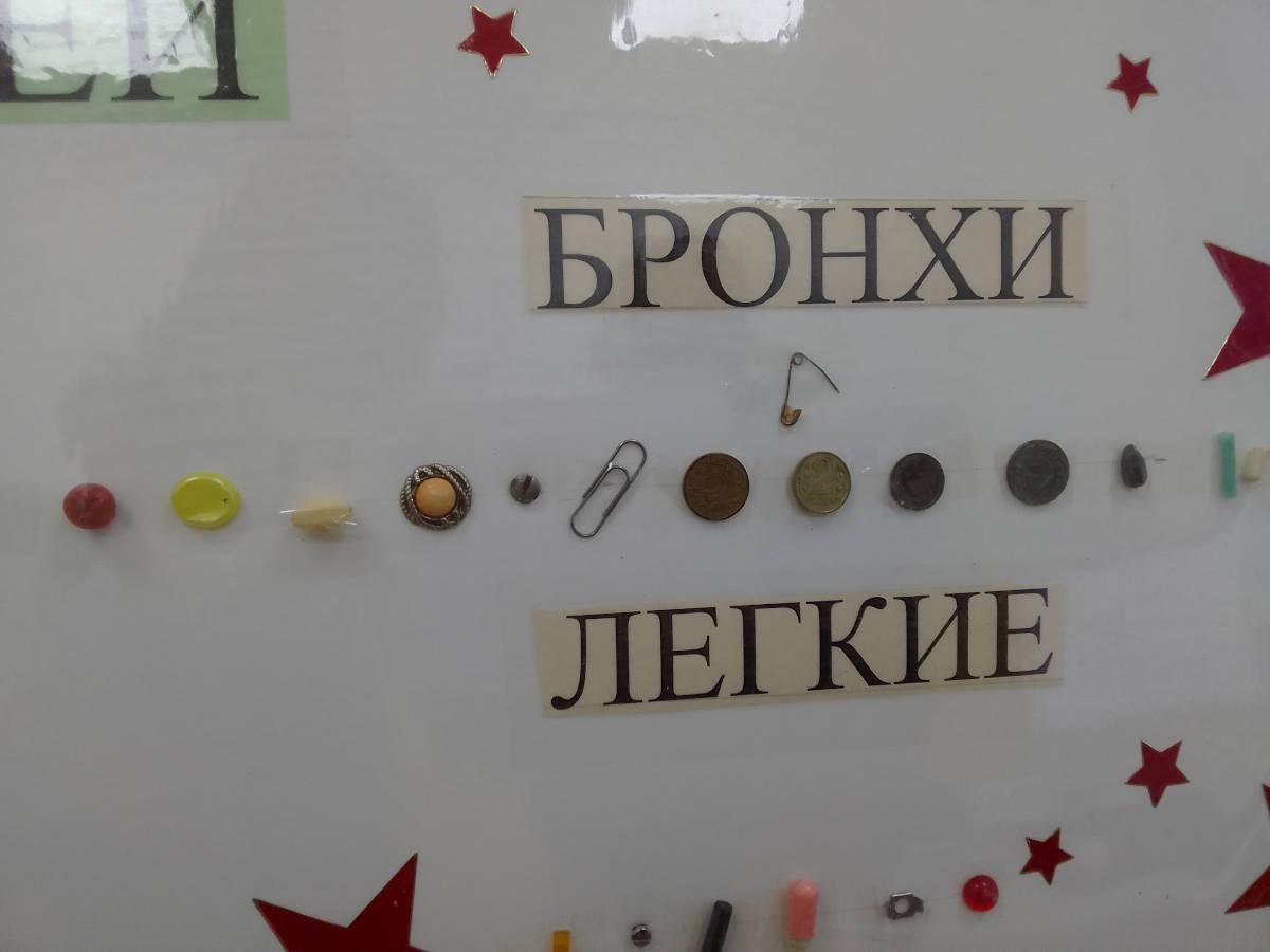 В Усть-Каменогорске «музей» проглоченных предметов постоянно пополняется новыми экспонатами